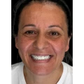 Rener-Amor-Review-Turkey-Dental-Implants