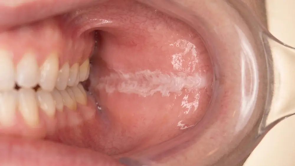 Fotografia intraorale ravvicinata di una linea bianca cheratosica sulla mucosa, che mostra chiaramente le conseguenze del morso guancia interna.