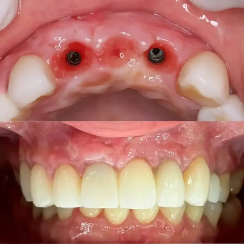 Close-up picture of a patient mouth before and after screwless dental implants
