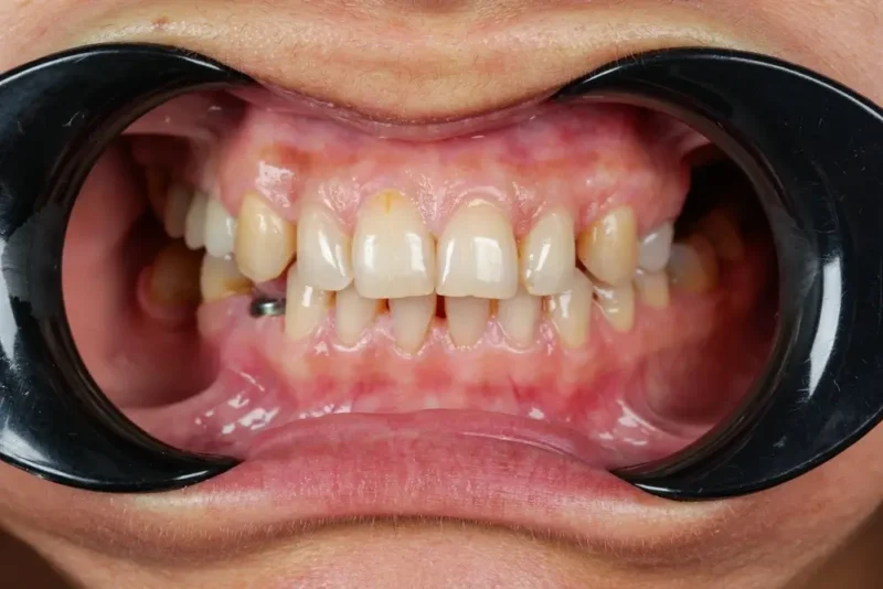 Intraoral photo with cheek retractors showing misaligned and crowded upper and lower teeth before treatment