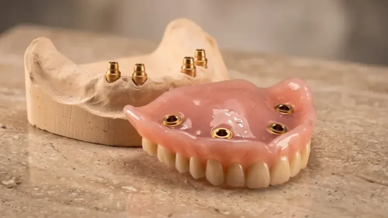 Implant-supported overdenture: removable dental prosthesis with ball attachments and a plaster model featuring four implants.