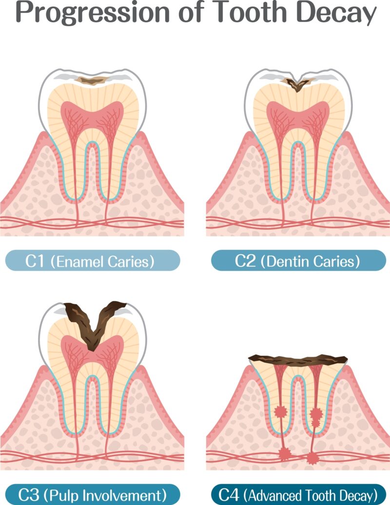 Medical illustration titled "Progression of Tooth Decay" showing the four tooth decay stages: enamel caries (C1), dentin caries (C2), pulp involvement (C3), and advanced tooth decay (C4).