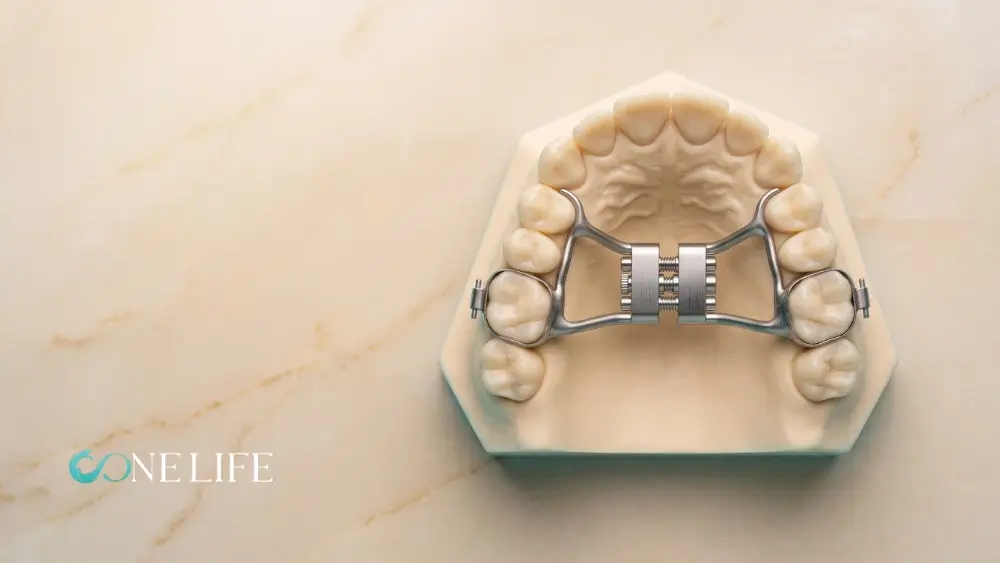 Top-down view of a metal palatal expander fitted on a dental model of an upper jaw, demonstrating orthodontic treatment for a crossbite.