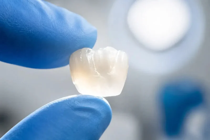Close-up of a dentist in blue gloves inspecting an Emax Dental Crown.