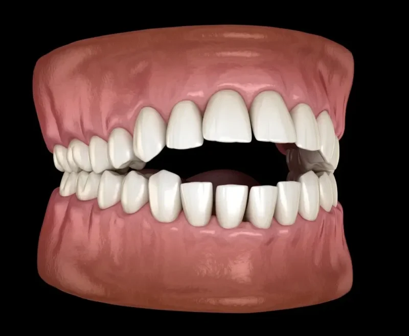 A digital 3D model of a human mouth on a black background showing a severe anterior open bite, where the back teeth are closed but the upper and lower front teeth do not meet.