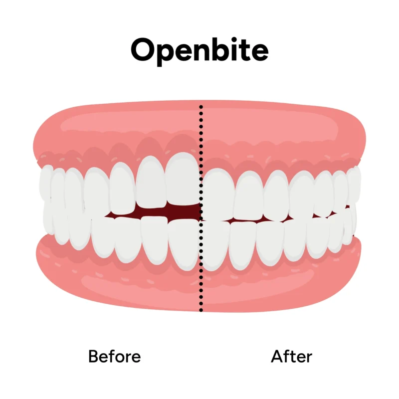 A split graphic demonstrating open bite treatment before and after. The left side shows the "before" state with a gap between the front teeth, while the right side shows the "after" state with a properly aligned bite.