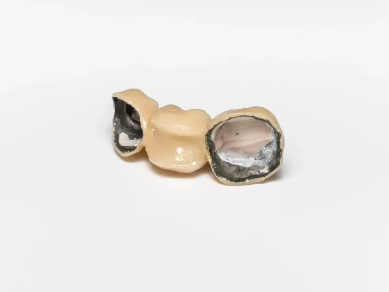 A three-unit PFM (porcelain-fused-to-metal) dental bridge on a white background.