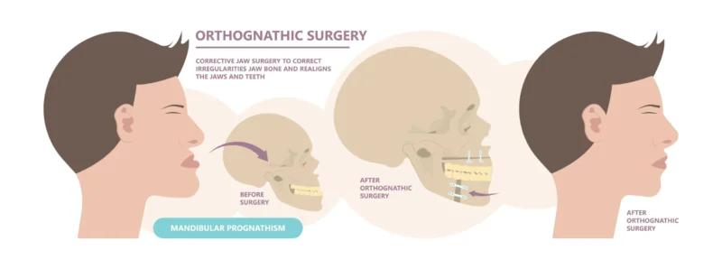 Prognathism surgery illustration showing a before and after sequence of a patient's profile and skull anatomy, detailing how orthognathic surgery corrects mandibular prognathism.