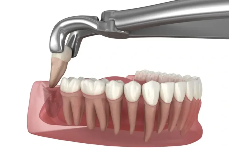 A detailed 3D medical illustration of a tooth extraction. Metallic dental forceps are gripping and removing a lower premolar tooth from its socket in the mandible bone and gum tissue.